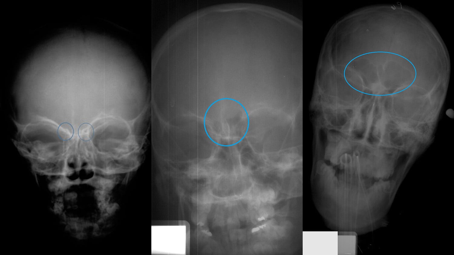 Трещина черепа у ребенка. Тангенциальный рентген черепа. Окостенение костей черепа рентген. Кости черепа рентген норма. Туберкулез лобной кости.
